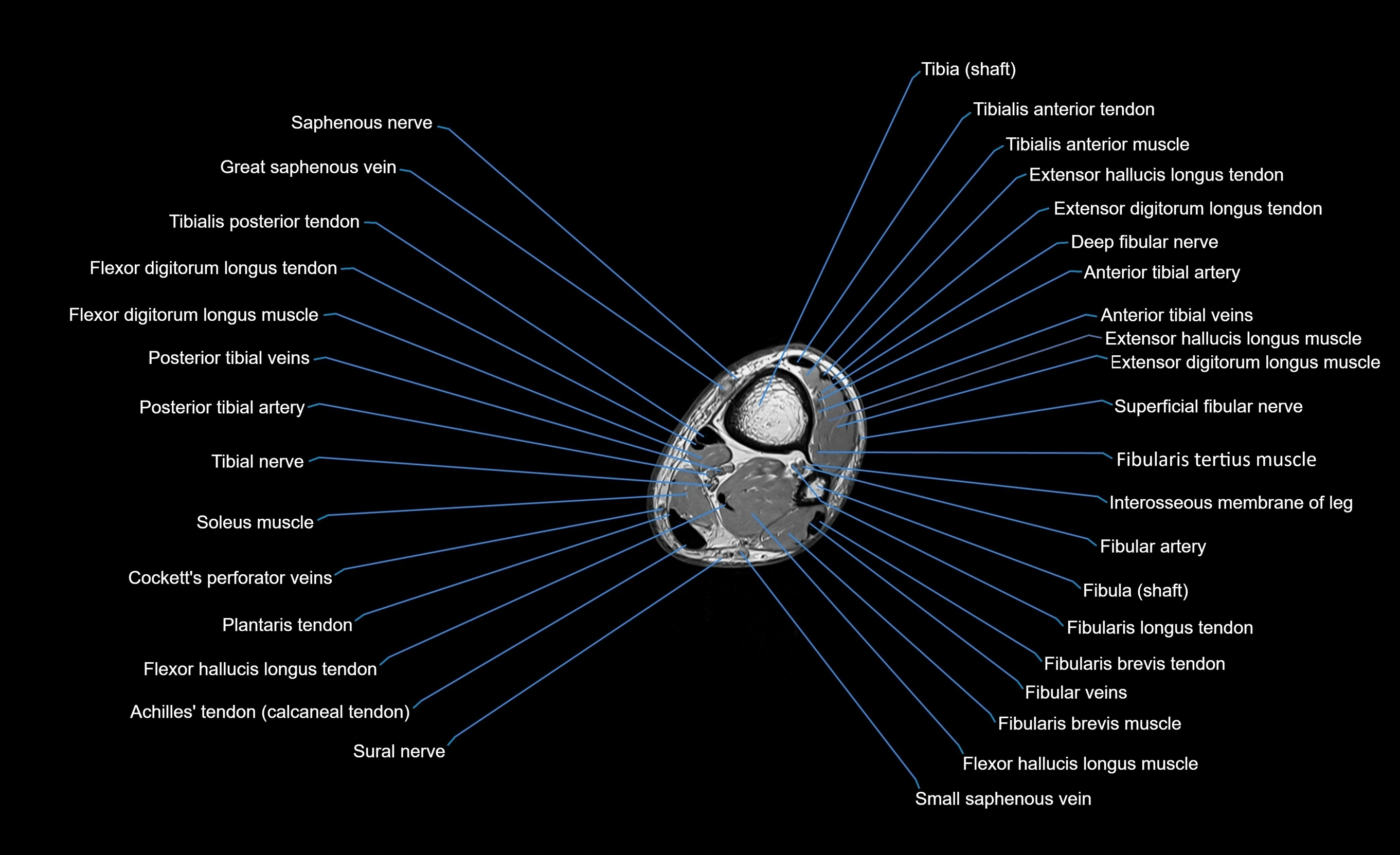 MRI lower leg axial cross sectional anatomy 3T  radiology  image-img-00001-00089.webp